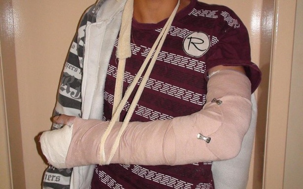 Adolescente afirmou aos policiais que havia quebrado o braço há alguns dias (Foto: Divulgação/PRF)